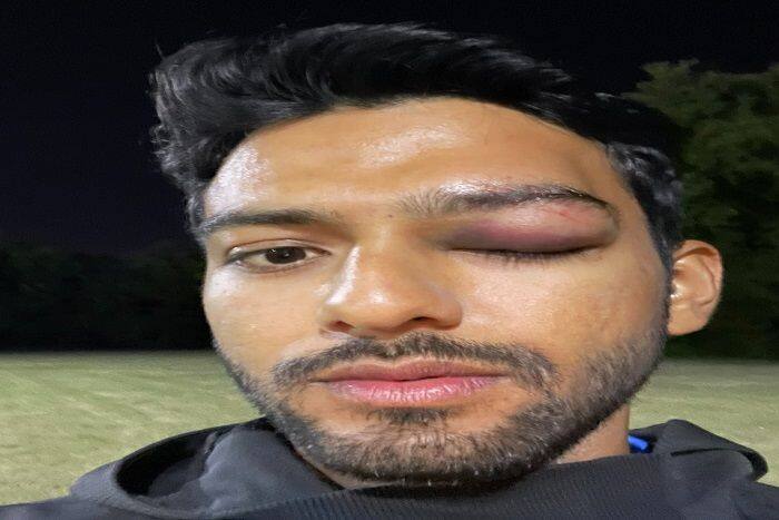 उन्मुक्त चंद को क्रिकेट मैच के दौरान आंख में लगी चोट, सोशल मीडिया पर पोस्ट किया फोटो 