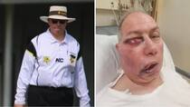 Australian umpire Hospitalised after Massive blow to face before Border-Gavaskar Trophy