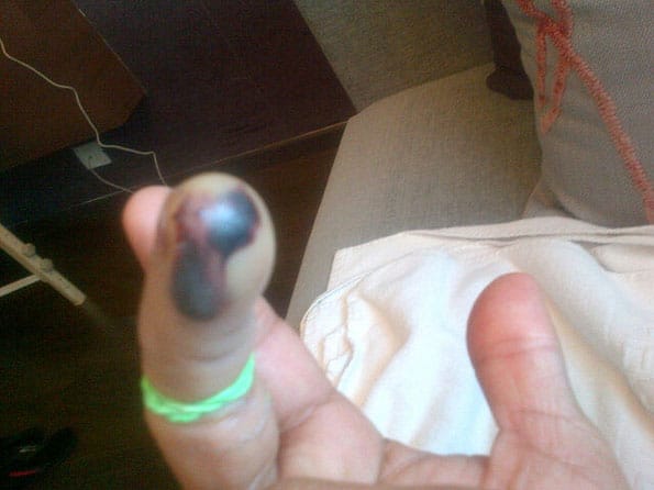 Sachin Tendulkar tweets picture of injured finger 